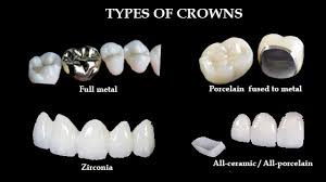 Ceramic Crowns
