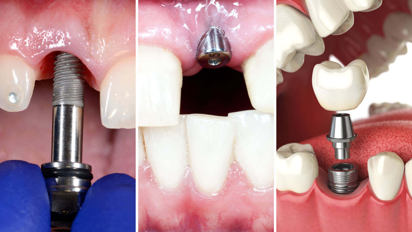 Implant Dentistry