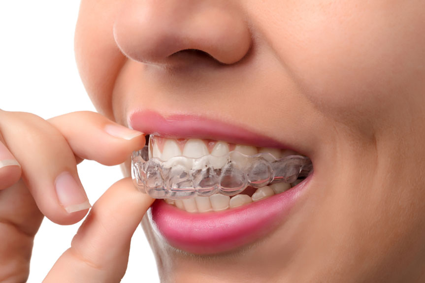 Invisalign® Treatment
