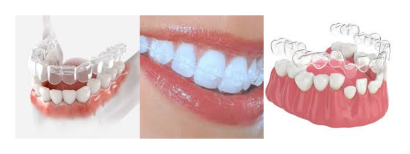 Clear Aligners