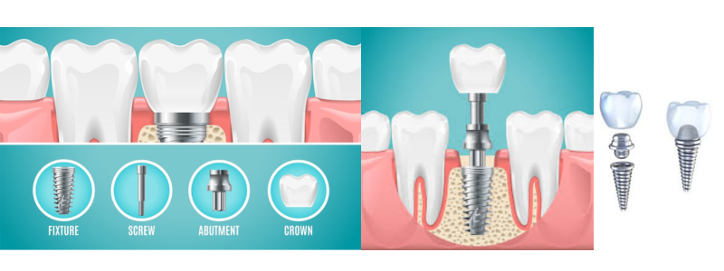 Dental Abutment