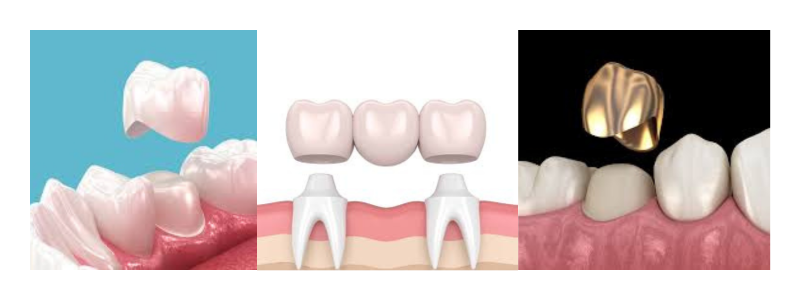 Dental Crowns