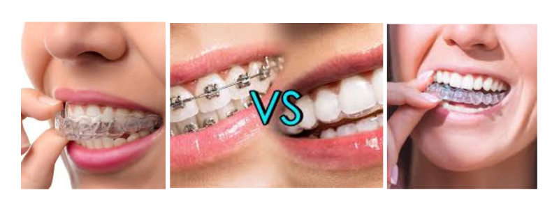 Invisalign® Treatment