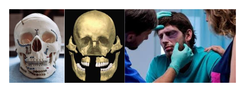 Facial Trauma
