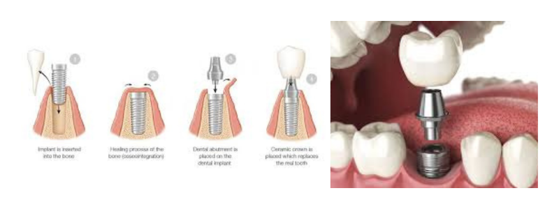 Implant Services