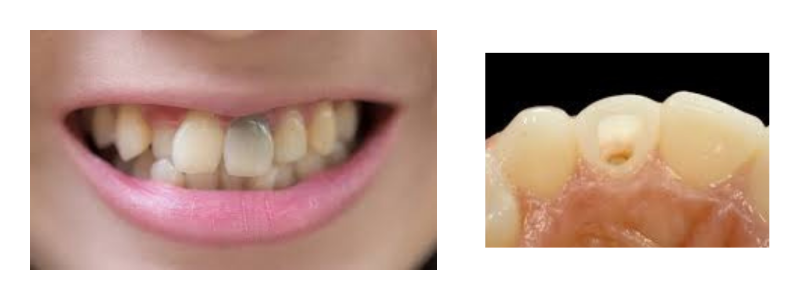 Internal Bleaching