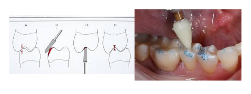 Occlusal Adjustment