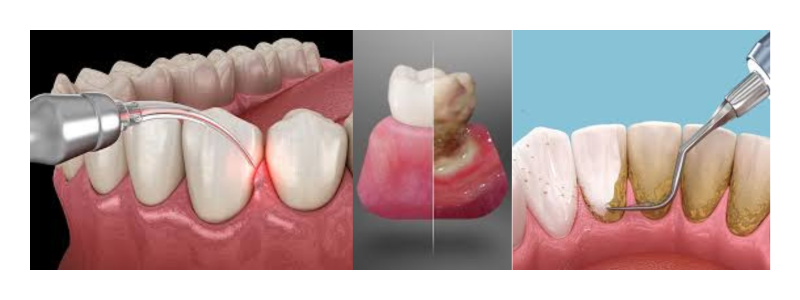 Dental Scaling and Root planning 