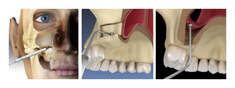 Sinus Lifts