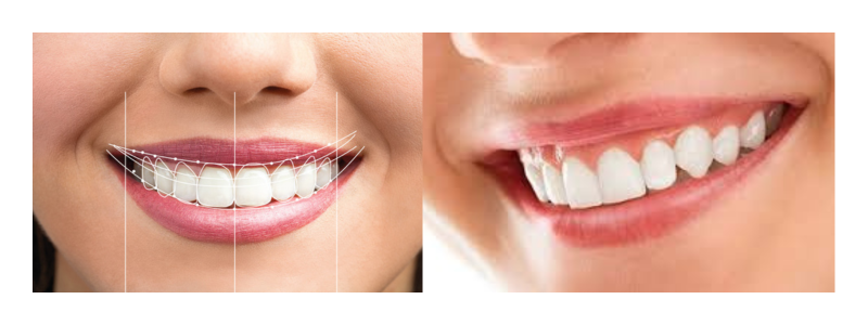 Smile Makeovers