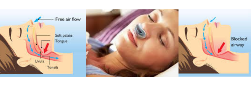 Snoring Treatment