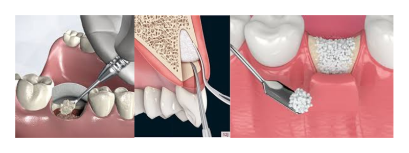 Socket Preservation
