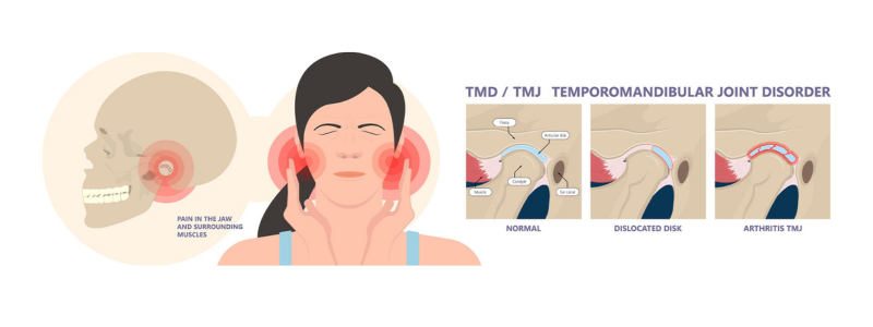 TMD Treatment