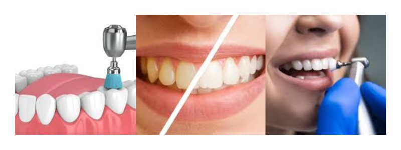 Teeth Polishing