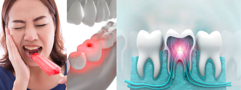 Tooth Sensitivity
