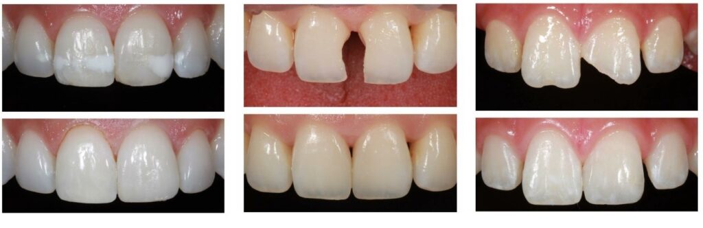 composite white fillings